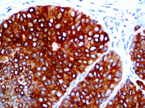 IHC of EpCAM on an FFPE Breast Cancer Tissue